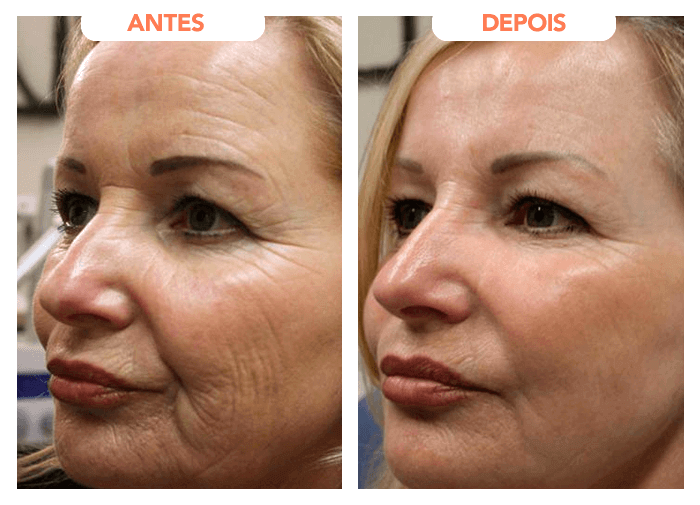 Antes e depois de Lúcia Hoffmann após 3 meses